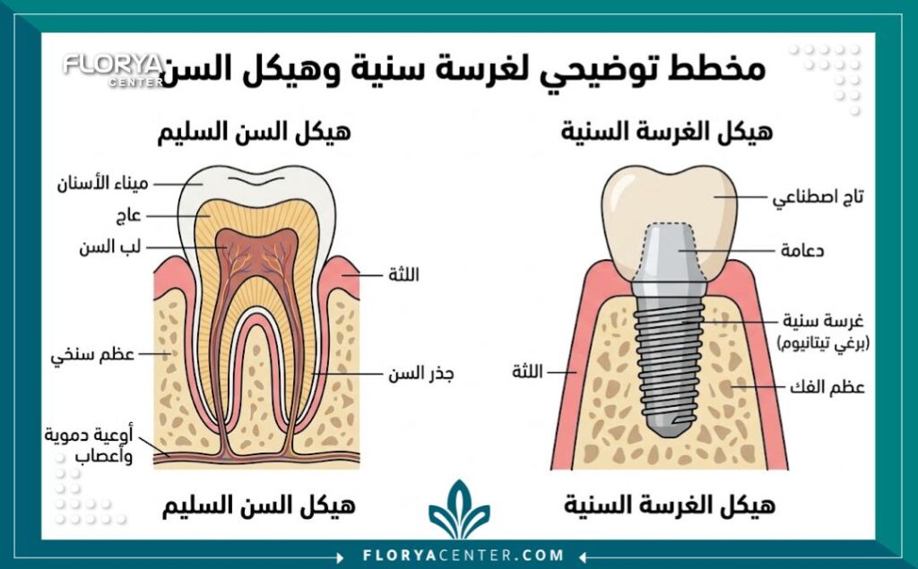 اسعار علاج الاسنان في تركيا 2 رسم تشريحي توضيحي لأجزاء زرعة الأسنان والتاج لمقارنة تكلفة العلاج
