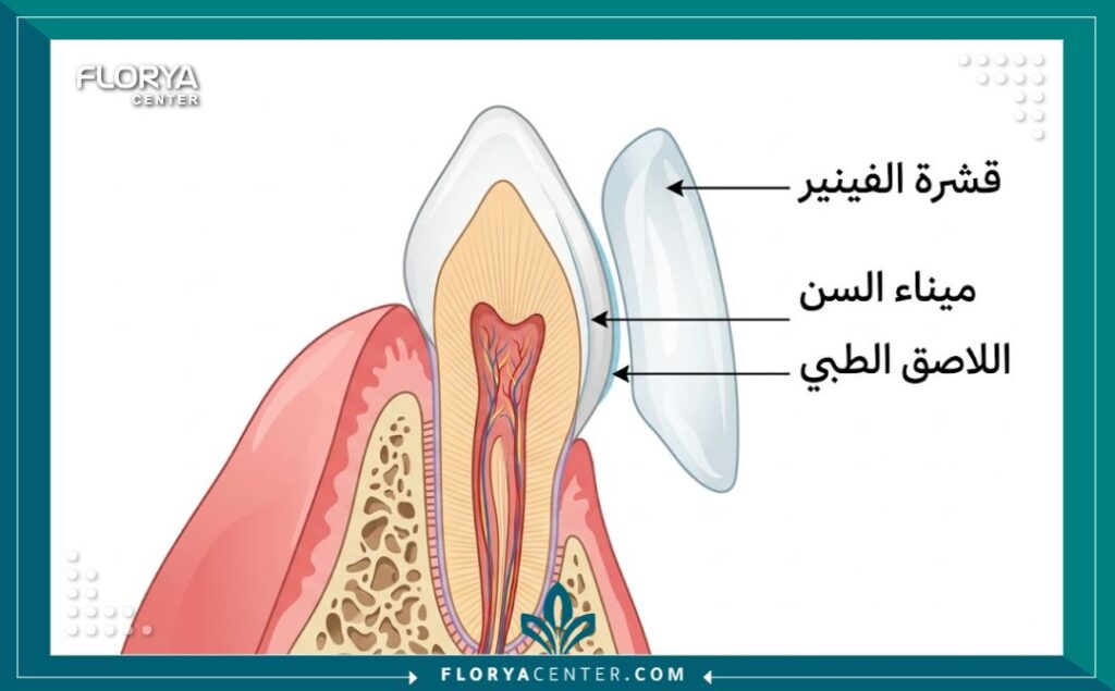 اسعار فينير الاسنان الامامية في تركيا 2 رسم توضيحي طبي يوضح كيفية تركيب قشرة فينير الأسنان الأمامية على طبقة المينا للحفاظ على السن.