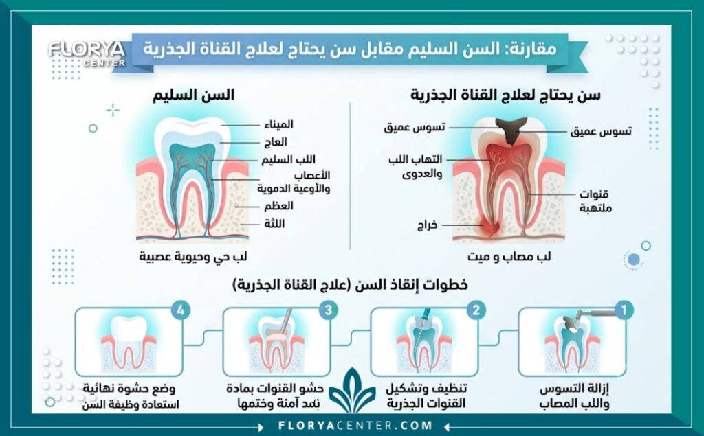 افضل دكتور سحب عصب في تركيا 3 إنفوجرافيك يقارن بين السن السليم والسن المصاب ويوضح أهمية علاج الجذور لتجنب خلع الأسنان.