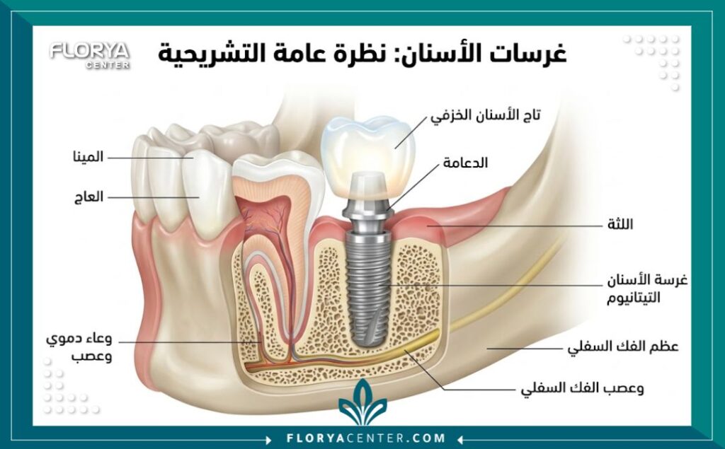 رسم توضيحي طبي مفصل لتركيب زراعة الأسنان، يوضح دقة ومهارة أمهر أطباء الأسنان في تركيا.