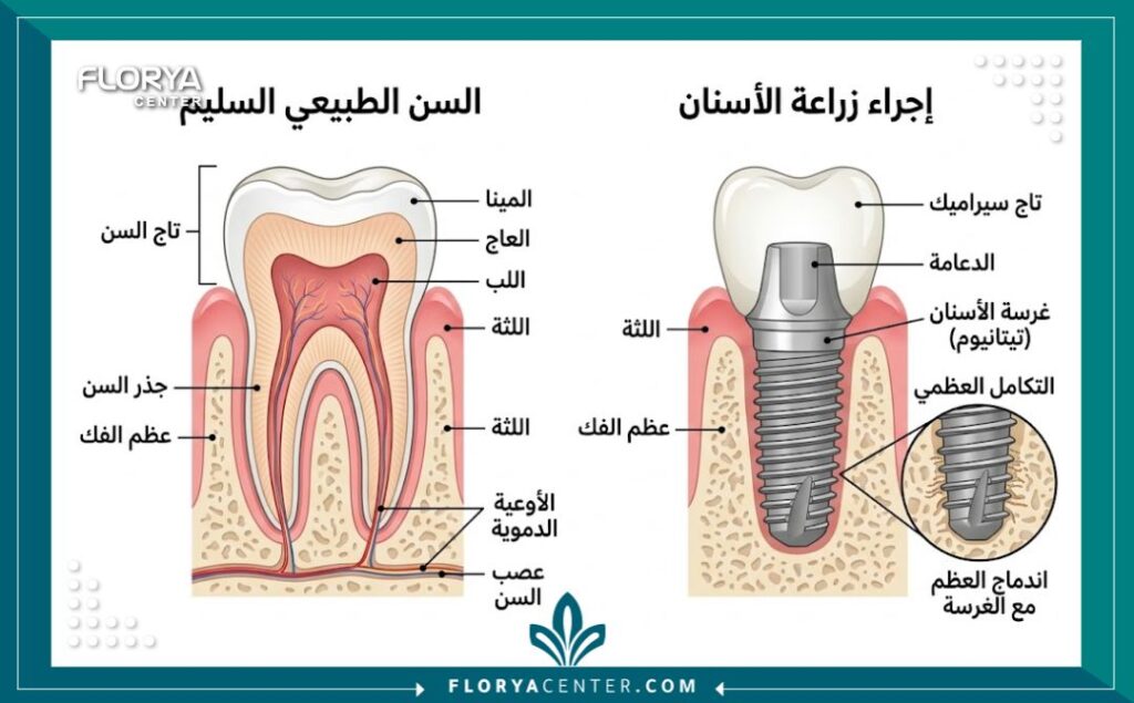 افضل عيادات الاسنان في تركيا 2 مخطط توضيحي طبي لخطوات زراعة الأسنان وتركيب التيجان في أفضل مراكز الأسنان المعتمدة.