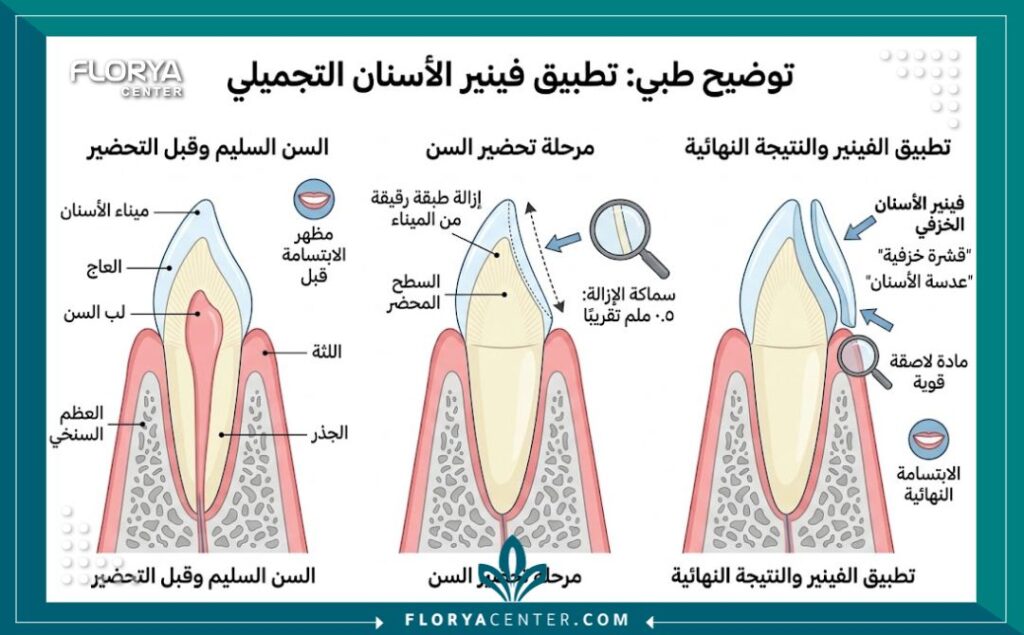 رسم توضيحي طبي يشرح كيفية تركيب عدسات الفينير لتجميل الأسنان في تركيا.