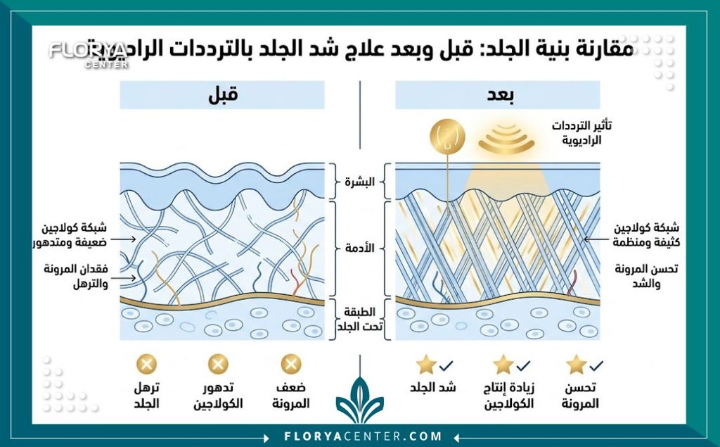 إنفوجرافيك يقارن بين حالة البشرة قبل وبعد استخدام تقنية الترددات الراديوية لشد الجلد المترهل بدون جراحة.