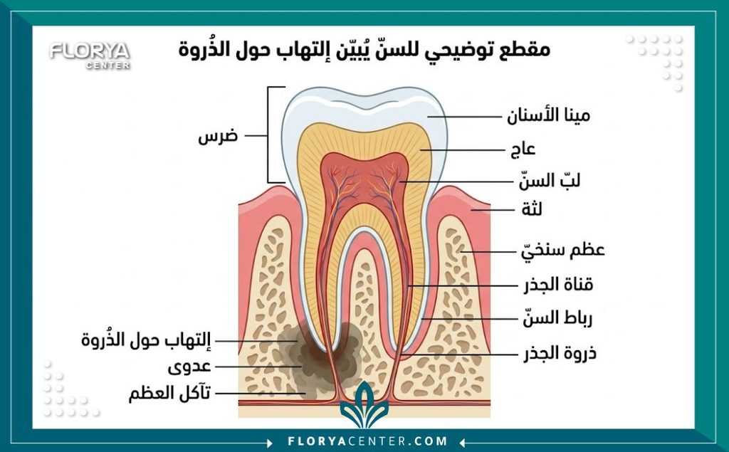 رسم توضيحي طبي لتشريح السن يوضح جذر السن ومكان الالتهاب الذي يكشفه التصوير الشعاعي الذروي.