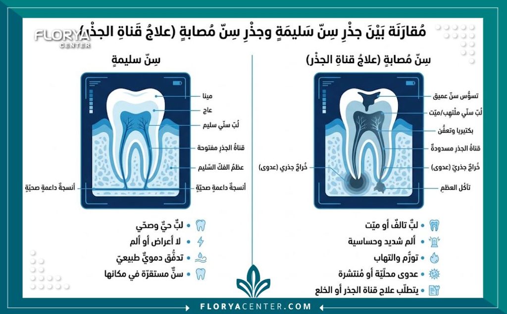 إنفوجرافيك يقارن بين السن السليم والسن الملتهب لتوضيح أهمية أشعة ذروة السن قبل علاج العصب.