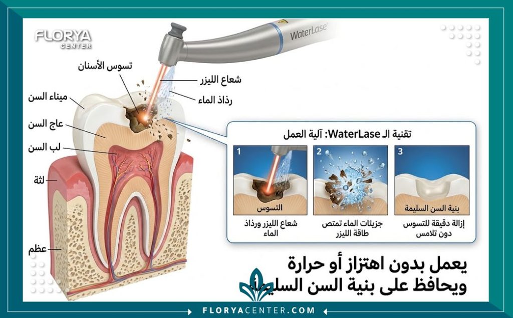 العلاج بالليزر المائي للاسنان في تركيا 2 رسم توضيحي يشرح آلية العلاج بالليزر المائي للاسنان وكيفية إزالة التسوس بدمج طاقة الليزر مع رذاذ الماء.