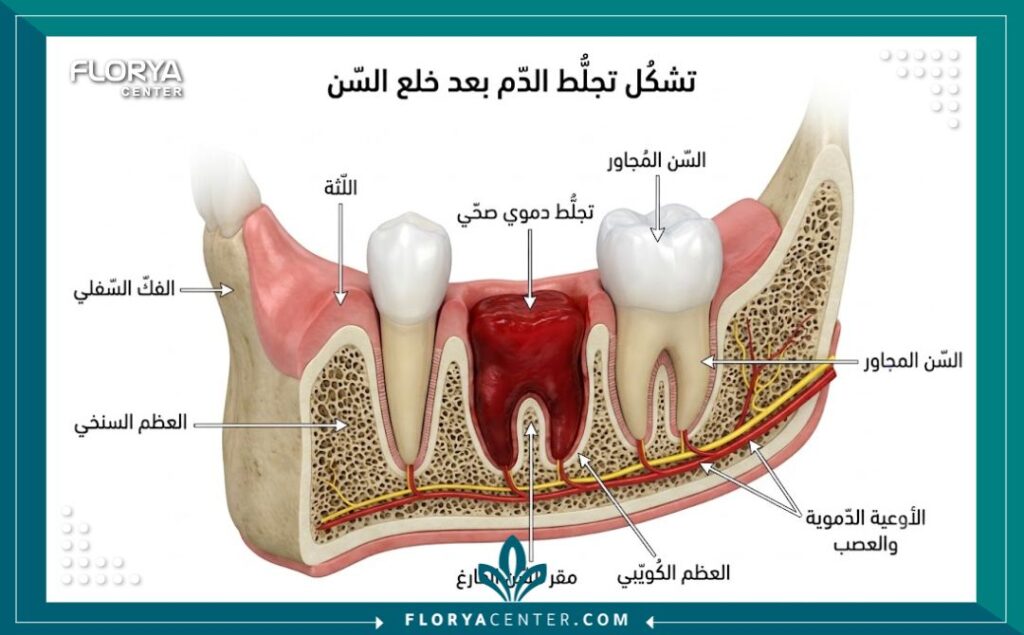 رسم طبي تشريحي يوضح كيفية تكون الجلطة الدموية داخل تجويف اللثة لوقف نزيف الدم بعد قلع السن.