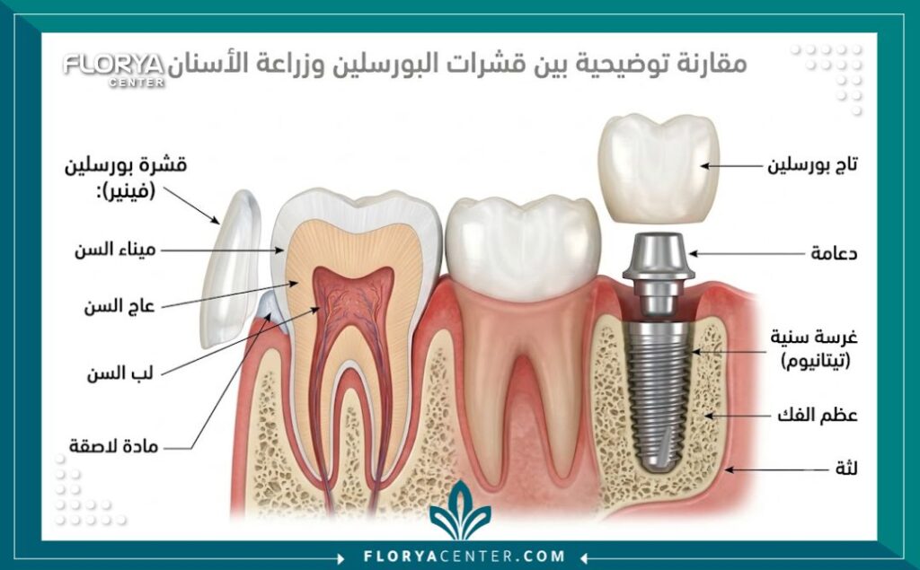 رسم توضيحي طبي يشرح تركيب قشور الفينير وزراعة الأسنان ضمن عروض تجميل الأسنان في تركيا.