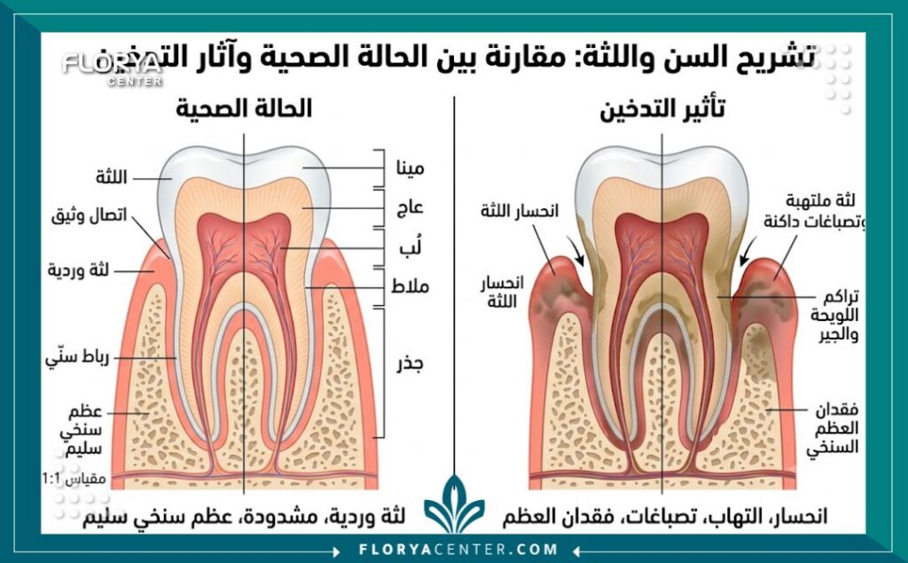 تأثير التدخين على اللثة 2 رسم توضيحي طبي يقارن بين تشريح اللثة السليمة وتراجع اللثة وفقدان العظم بسبب التدخين.