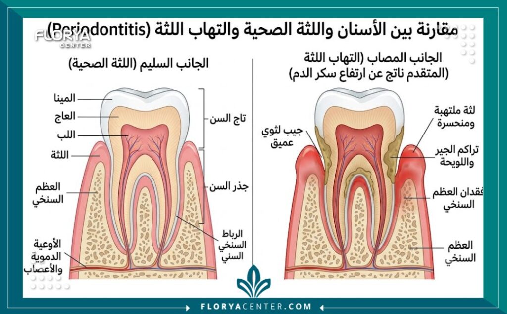 تأثير السكري على الاسنان 2 رسم توضيحي طبي لتشريح السن يظهر التهاب اللثة وتراجعها كأحد مضاعفات وتأثير السكري على الأسنان.