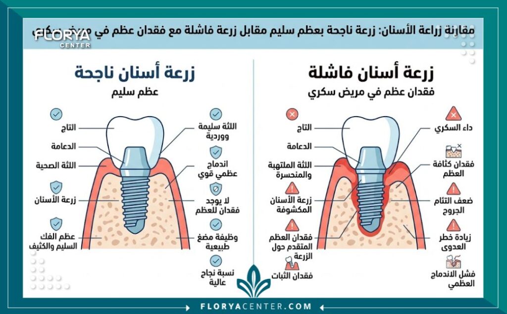تأثير السكري على الاسنان 3 إنفوجرافيك طبي يقارن بين نجاح زراعة الأسنان وأسباب فشل الزرعات وتآكل عظام الفك لدى مرضى السكري.