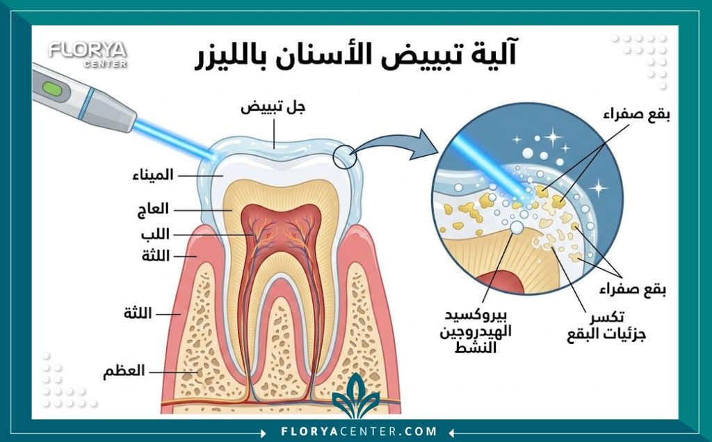 تبييض الاسنان الكيميائي الضوئي 2 رسم طبي يوضح كيف يخترق ضوء الليزر الأزرق ومادة البيروكسيد طبقات المينا لإزالة اصفرار السن.
