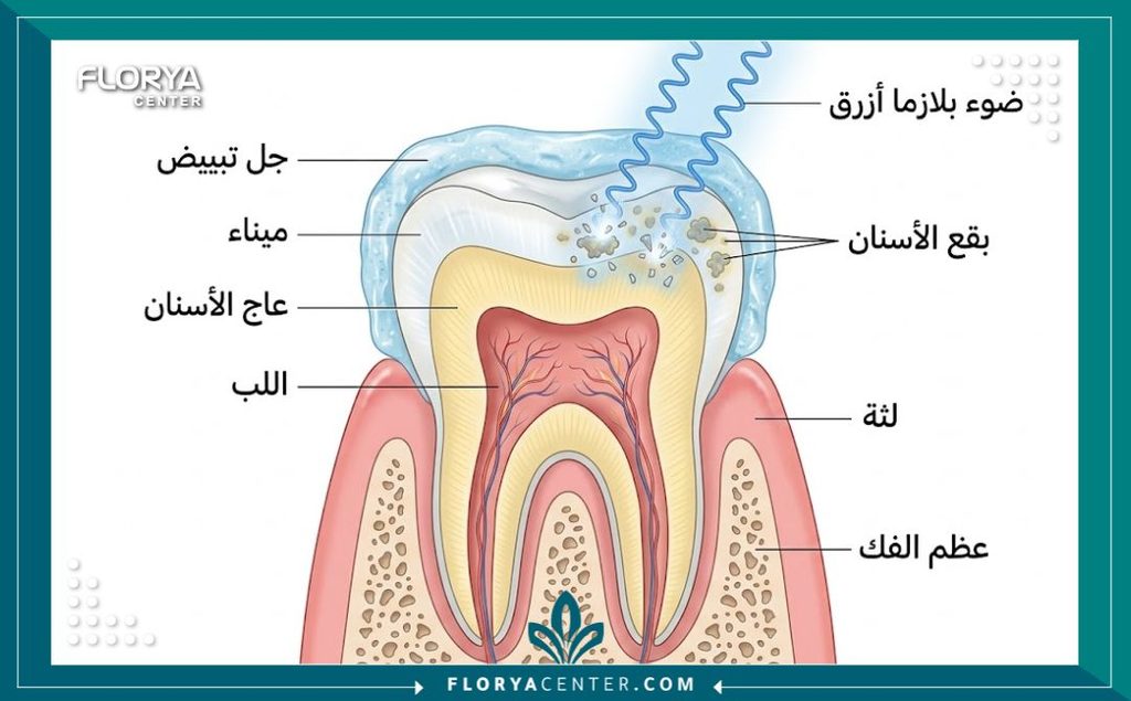 رسم توضيحي طبي يشرح آلية تبييض الأسنان بالبلازما وتفاعل الضوء المسرع مع جل التبييض على طبقة المينا.