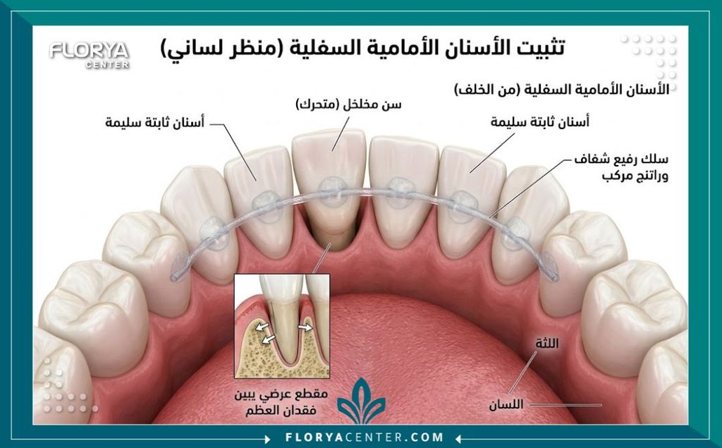 رسم توضيحي طبي ثلاثي الأبعاد يبين آلية تثبيت الاسنان المتحركة بالجبيرة من الخلف لربط السن المتخلخل بالأسنان الثابتة.