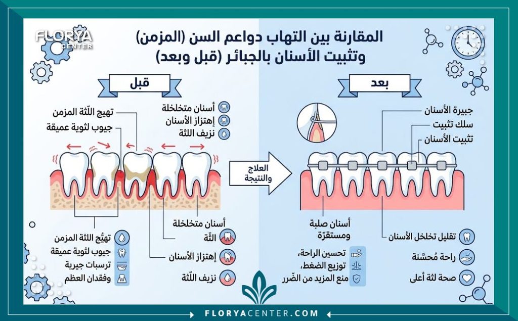 إنفوجرافيك يقارن بين حالة الأسنان قبل وبعد علاج تخلخل الأسنان باستخدام تقنية تثبيت الاسنان المتحركة بالجبيرة الطبية.