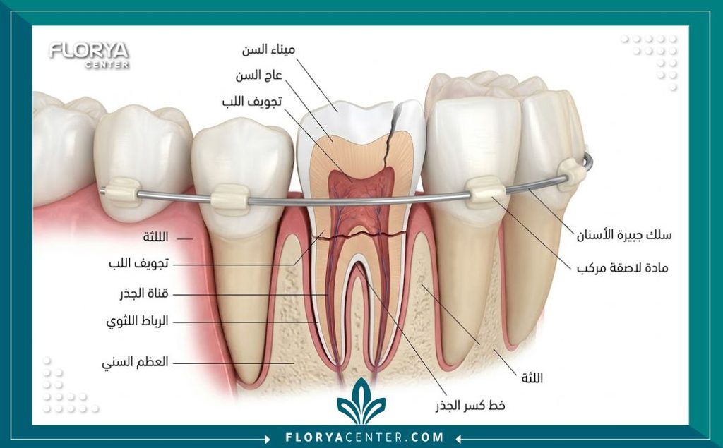 رسم طبي يوضح التشريح الداخلي للسن المكسور وكيفية تثبيته بالأسنان المجاورة.