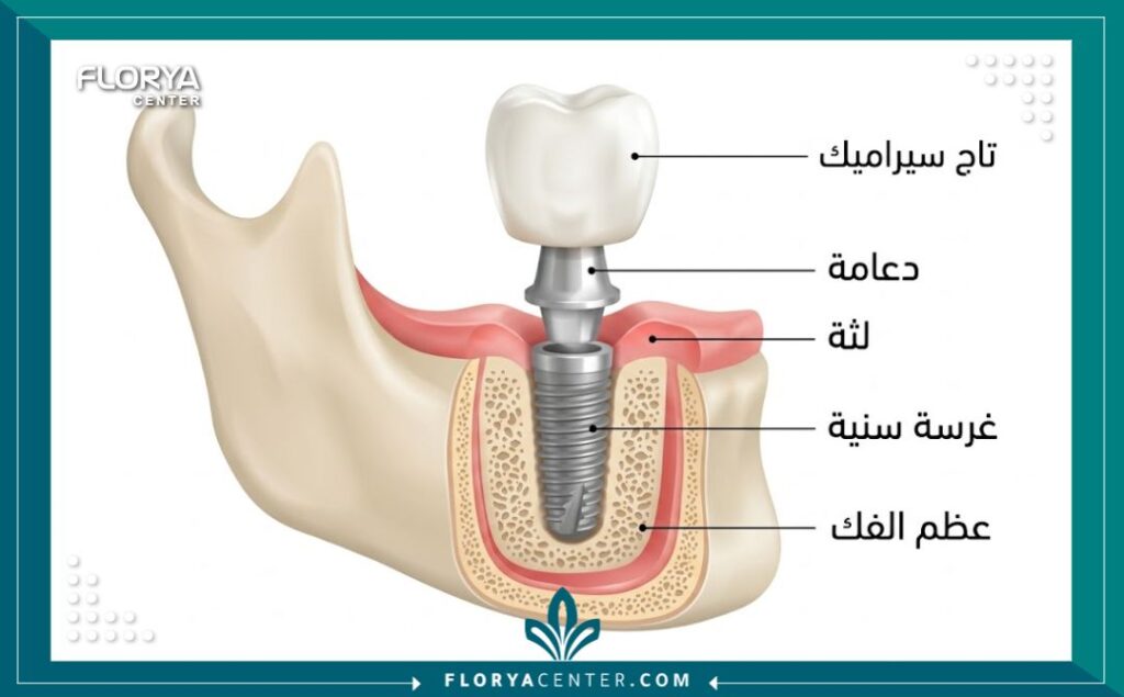 رسم توضيحي طبي يشرح تركيب زراعة الأسنان وتفاصيل المسمار والتاج داخل الفك.