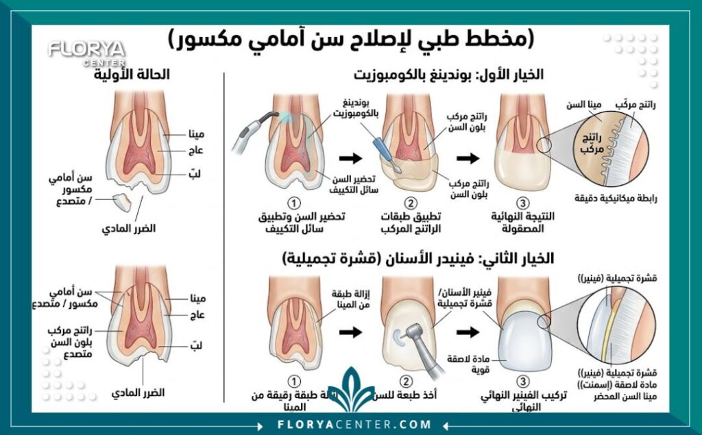 تجميل الاسنان الامامية المكسورة 2 رسم توضيحي طبي يوضح طبقات السن وطريقة إصلاح الكسر في الأسنان الأمامية باستخدام التقنيات الحديثة.