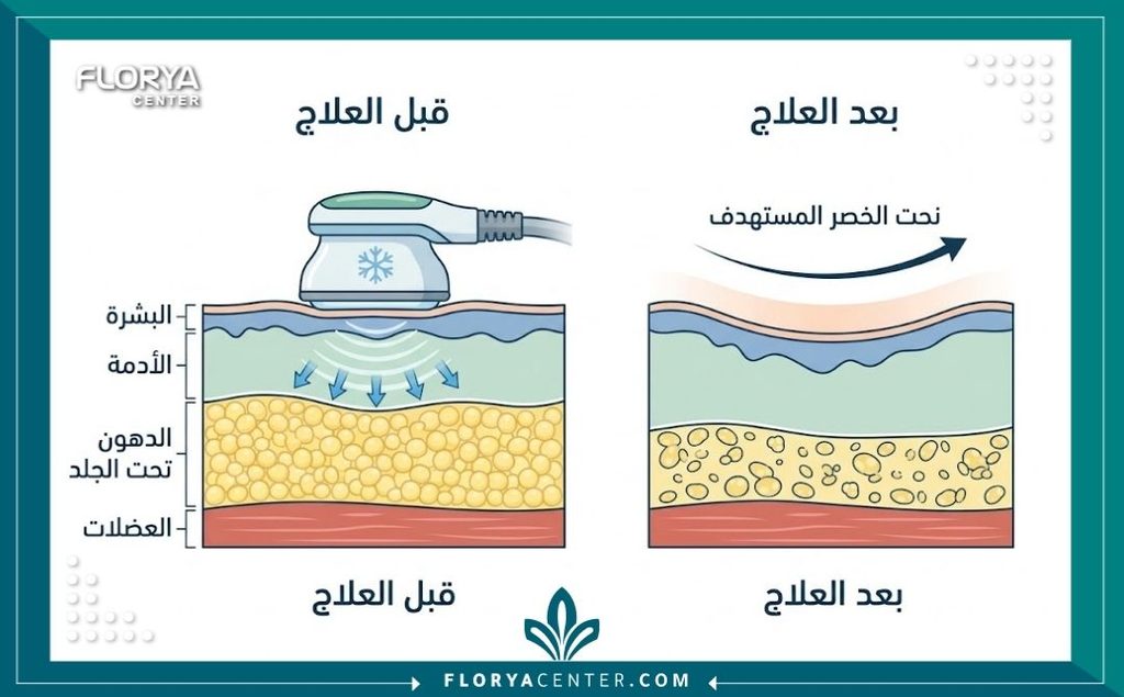 رسم توضيحي طبي لآلية عمل أجهزة النحت السريع وشفط الدهون الموضعي للعروس.