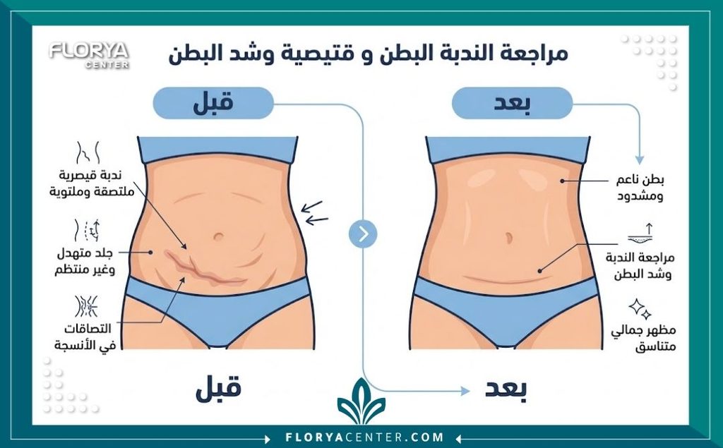 إنفوجرافيك يقارن بين شكل البطن قبل وبعد استغلال عملية الشد لقص ندبة قيصرية مائلة وتحسين ملمس الجلد.