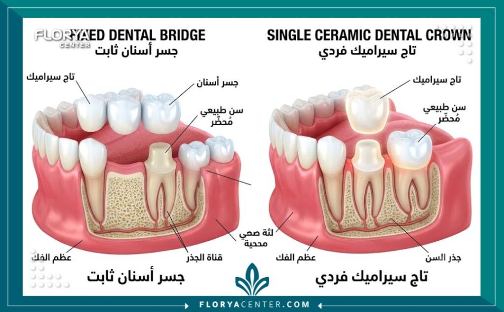 رسم توضيحي طبي يوضح تشريح وكيفية عمل الجسور والتيجان في تركيبات الاسنان الثابتة.