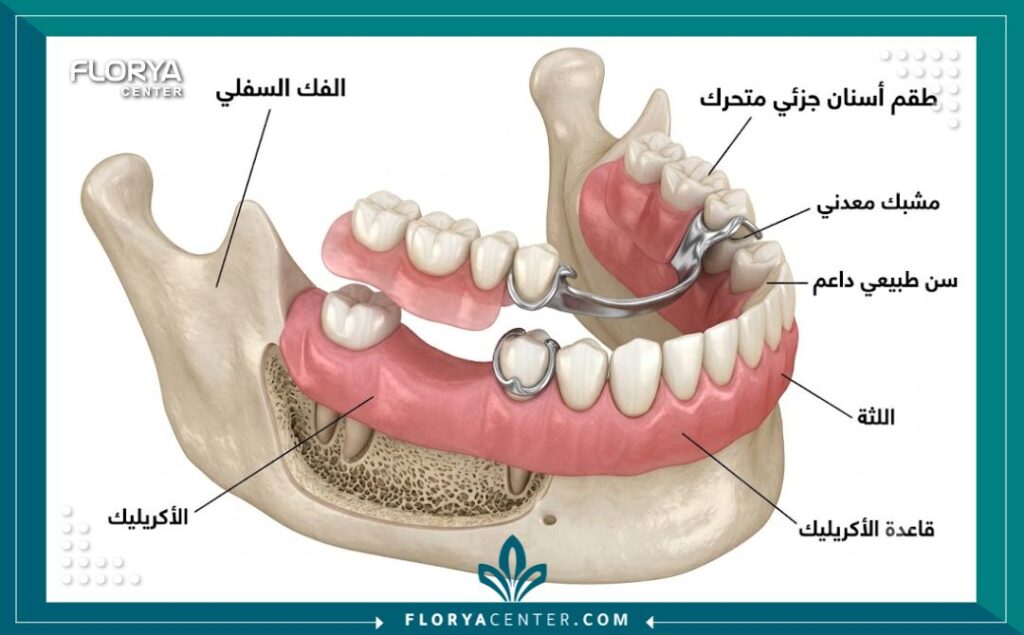 تركيبات الاسنان المتحركة 2 رسم توضيحي طبي يبين كيفية تثبيت الأطقم الجزئية في تركيبات الاسنان المتحركة على اللثة.