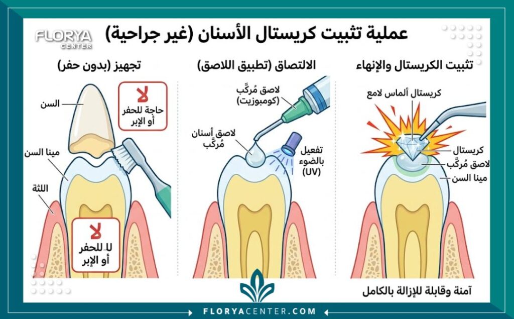 رسم توضيحي طبي يشرح خطوات تركيب كرستالة الاسنان بأمان تام وبدون الحاجة لحفر السن.