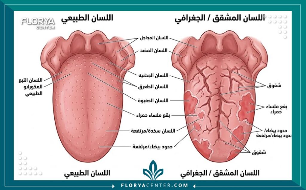 تشققات اللسان 2 رسم توضيحي طبي لتشريح الفم يوضح الفرق بين اللسان الطبيعي وحالة تشققات اللسان الحميدة.