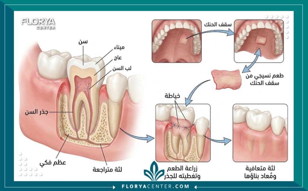 رسم توضيحي طبي يشرح خطوات عملية تطعيم اللثة وأخذ نسيج من سقف الحلق لترقيع اللثة المتراجعة.