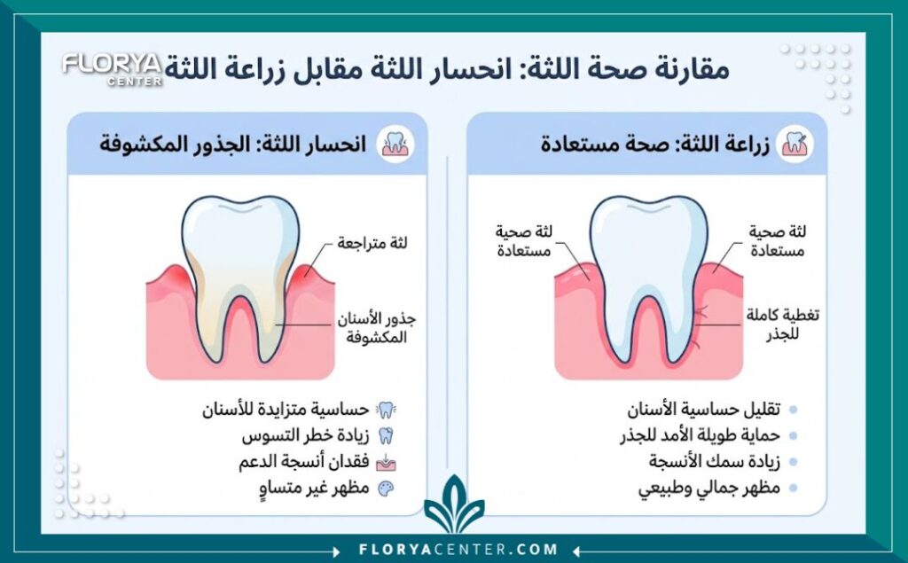 إنفوجرافيك يقارن بين حالة الأسنان قبل وبعد عملية ترقيع اللثة وعلاج تراجع اللثة.