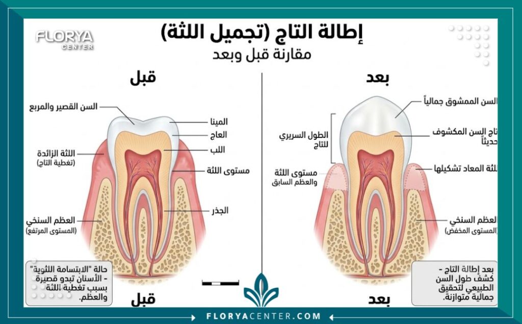 تطويل الاسنان في تركيا 2 رسم توضيحي طبي يشرح تشريح السن وعملية قص اللثة لتطويل الأسنان المربعة والقصيرة.
