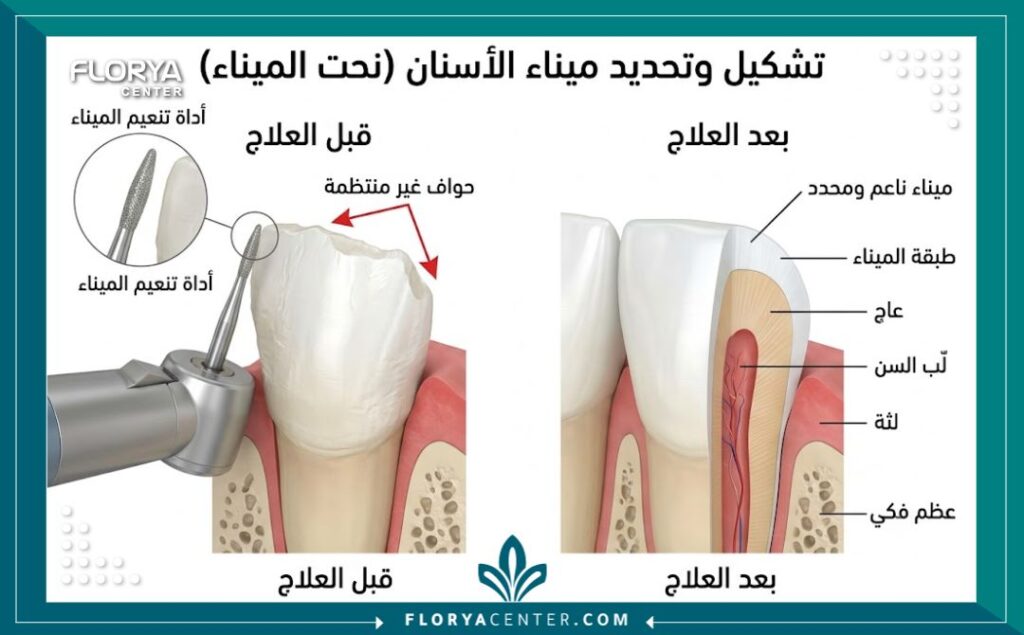 تعديل شكل الاسنان في تركيا 2 رسم توضيحي طبي لطبقات السن يوضح كيفية برد وتعديل حواف الأسنان المتعرجة.