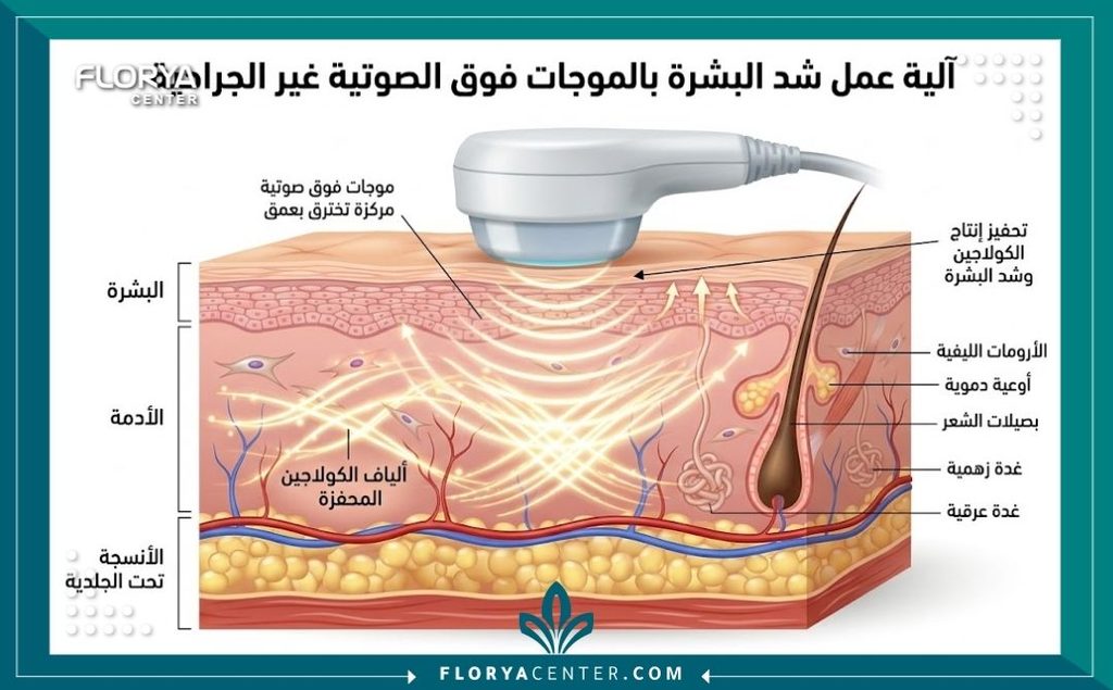 رسم توضيحي طبي يظهر طبقات الجلد وكيفية تحفيز الكولاجين باستخدام موجات شد الجلد بدون جراحة.
