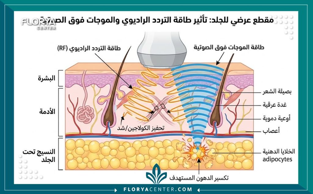 رسم توضيحي طبي لطبقات الجلد يوضح كيفية عمل جهاز الإكزيليس باستخدام الراديو فريكونسي والموجات فوق الصوتية لإذابة الدهون.