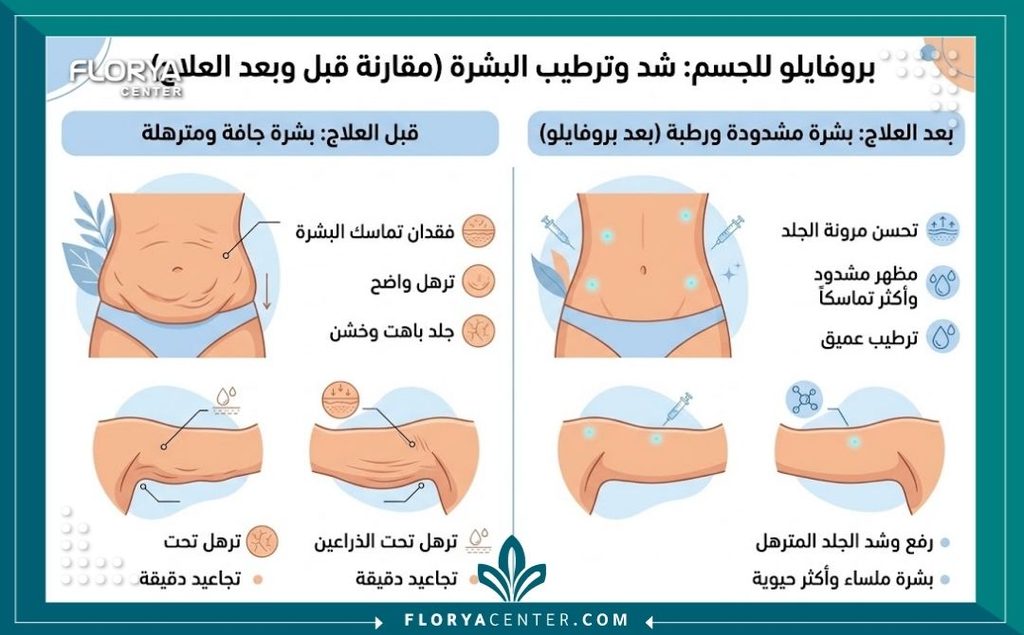إنفوجرافيك يقارن بين الجلد قبل وبعد حقن البروفايلو للبطن والزنود لترطيب وشد الترهلات العميقة.