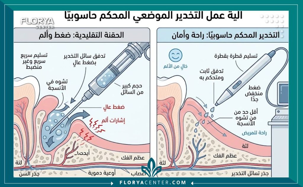 رسم توضيحي يشرح آلية عمل تقنية الفيس برايس للتخدير الكمبيوتري الدقيق ومقارنته بالإبرة التقليدية.
