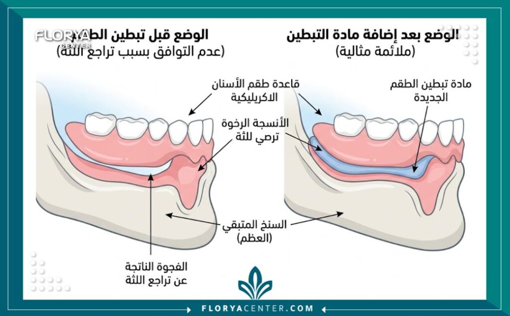 رسم توضيحي طبي يشرح عملية تبطين طقم الأسنان ليتلاءم بشكل مريح مع اللثة المتقلصة.