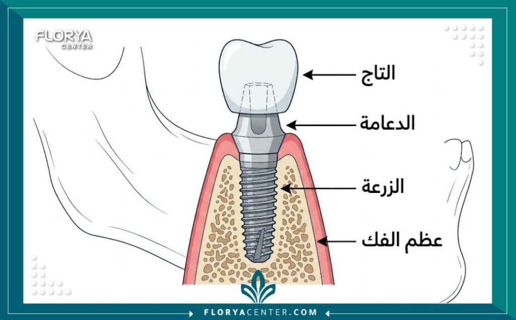 رسم تخطيطي طبي يوضح تشريح ومكونات غرسة الأسنان المصنوعة من التيتانيوم والتاج.
