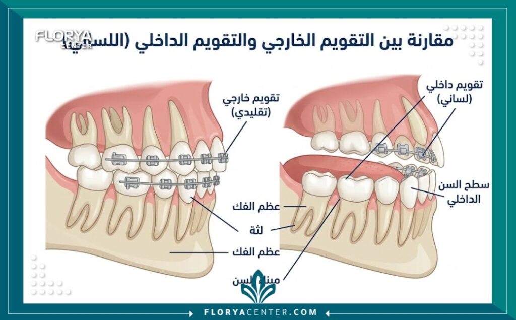 رسم توضيحي طبي يشرح آلية ومكان تركيب التقويم اللساني الداخلي خلف الأسنان