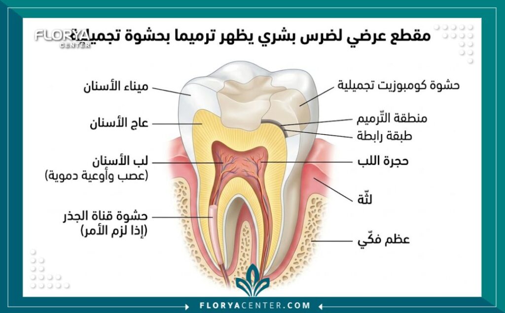 مخطط تشريحي يوضح كيفية تركيب الحشوة التجميلية البيضاء للأسنان وطبقات المينا