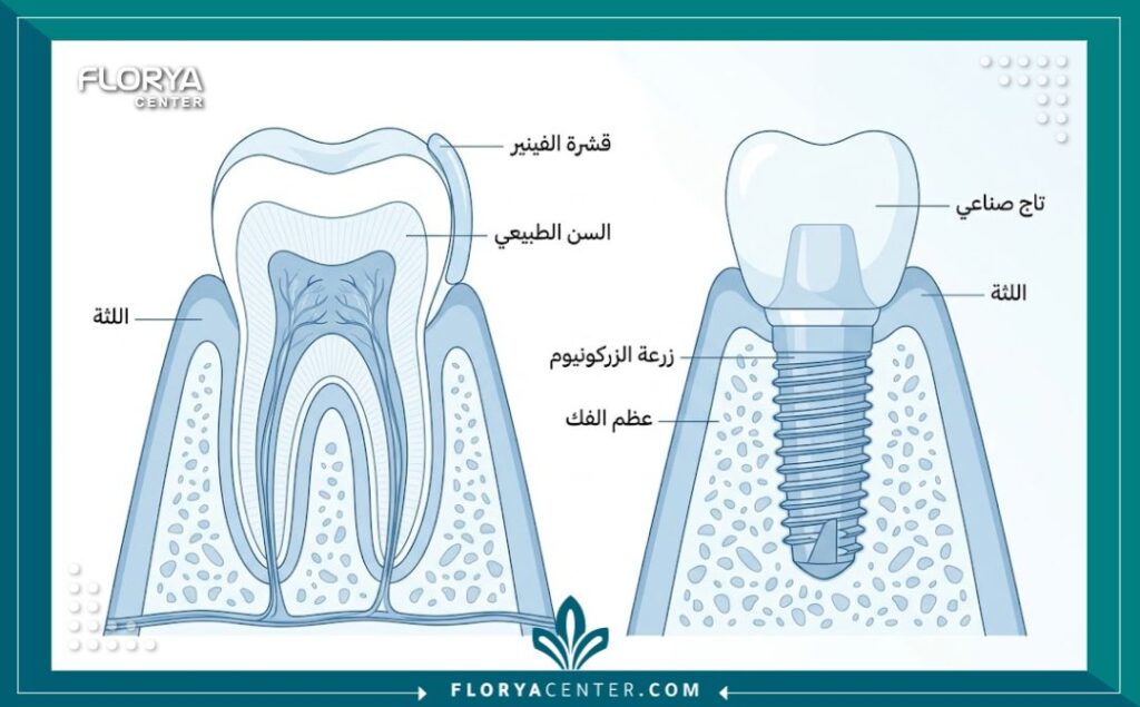 رسم تخطيطي طبي يوضح أجزاء الفينير والزراعة وتأثير النوع على أسعار وتكلفة تجميل الأسنان في تركيا.