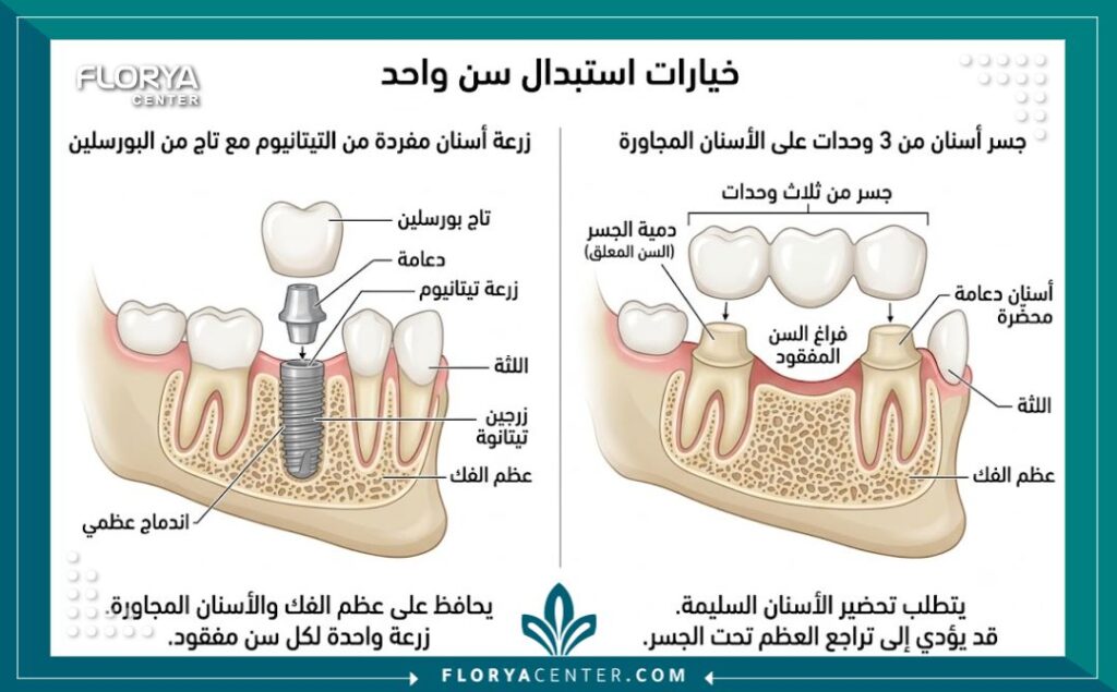 رسم تخطيطي طبي يوضح الفرق بين زراعة ضرس مفرد وجسر الأسنان لتعويض سن مفقود