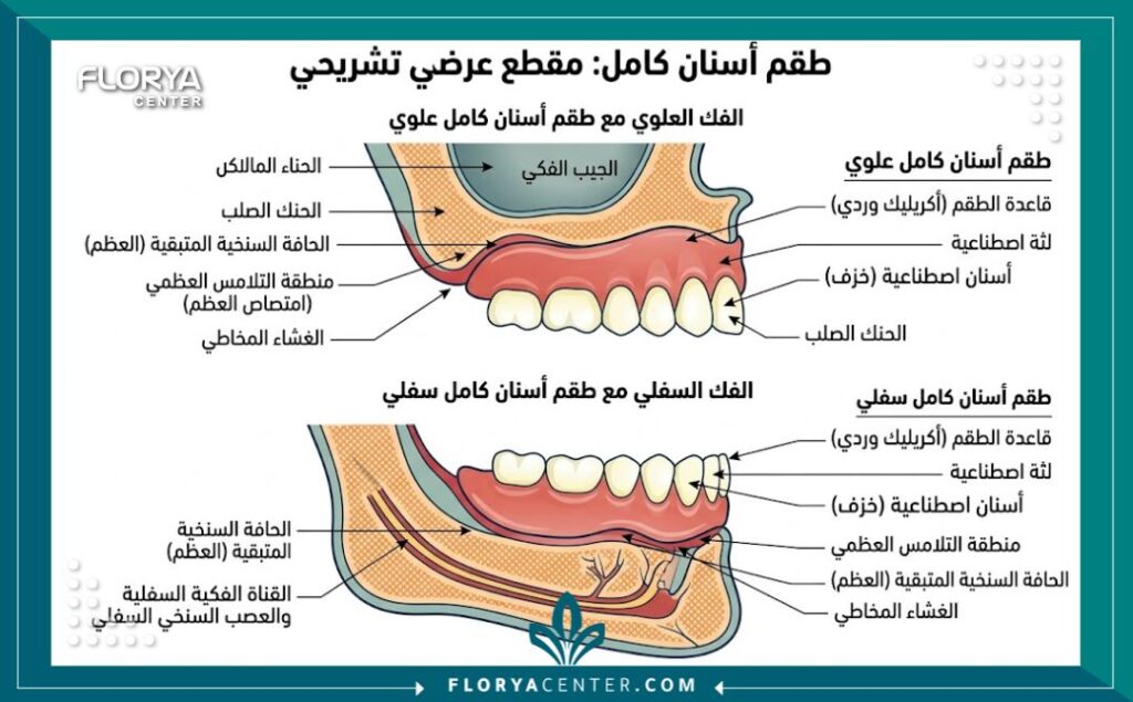 مخطط تشريحي يوضح أجزاء طقم الأسنان الكامل وكيفية تثبيته على الفك العظمي.