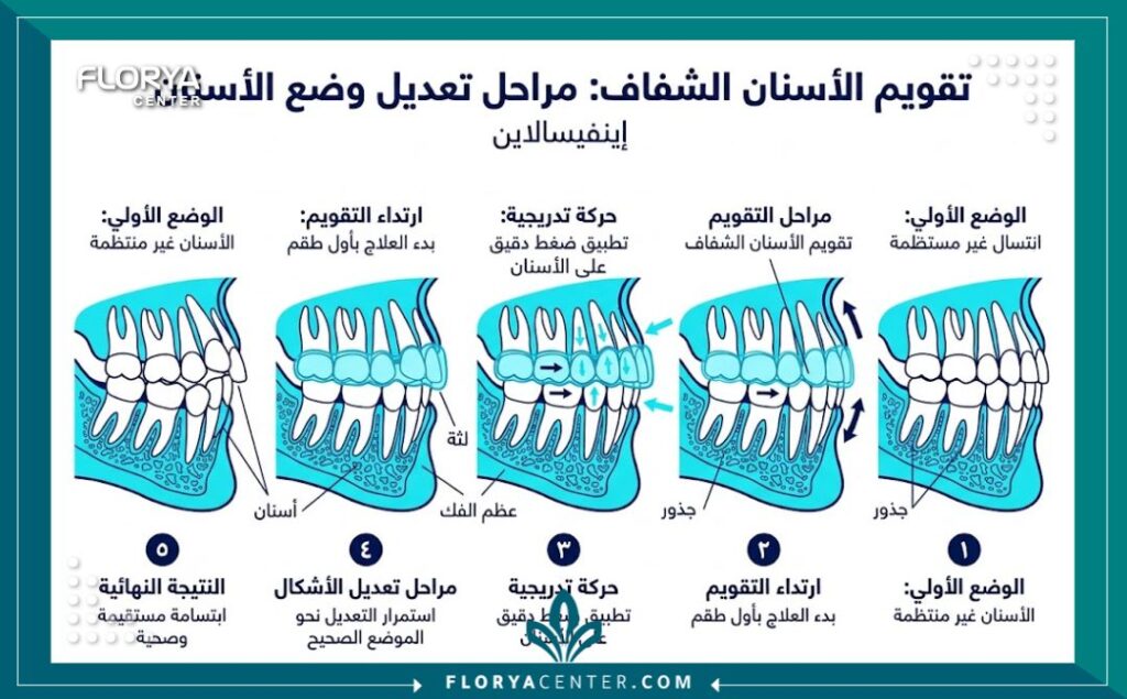 مخطط طبي توضيحي يظهر آلية عمل تقويم الانفزلاين الشفاف وتحريك الأسنان في تركيا.