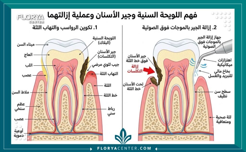 مخطط طبي يوضح طريقة تنظيف الجير وإزالة التراكمات الكلسية من الأسنان