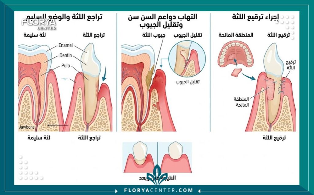 رسم توضيحي طبي يوضح تشريح اللثة وأنواع جراحات اللثة مثل تنظيف الجيوب وترقيع اللثة
