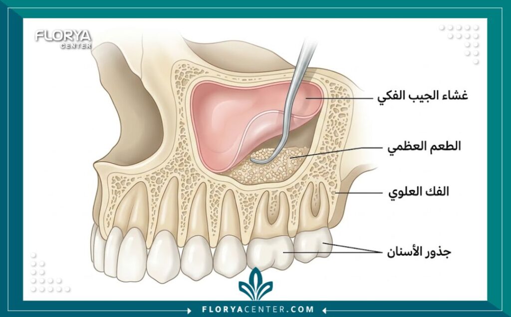 رسم توضيحي طبي يظهر خطوات رفع غشاء الجيب الفكي وزراعة العظم في الفك العلوي.