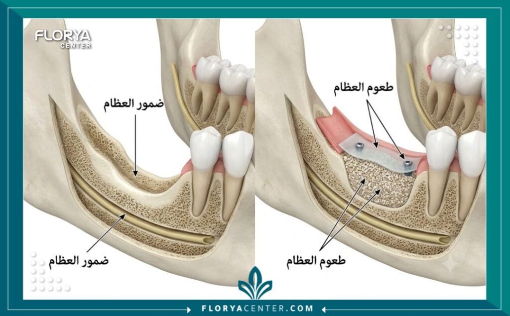 تكلفة زراعة عظم الفك في تركيا 2 توضيح طبي لمراحل زراعة عظم الفك لعلاج ضمور العظام قبل تركيب الأسنان في تركيا.