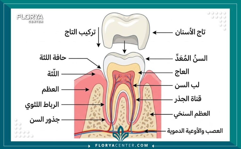 تكلفة طربوش السن في تركيا 2 رسم توضيحي طبي يشرح تشريح السن ويوضح كيفية تركيب تاج الأسنان أو طربوش السن لحمايته من التلف.