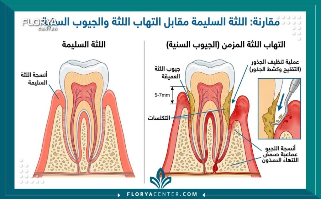 رسم توضيحي تشريحي يبين جيوب اللثة والتكلسات وطريقة كشط الجذور لوقف نزيف اللثة.